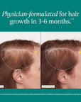 Nutrafol Women's Balance Hair Growth Supplements